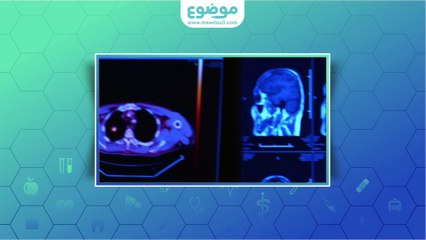 #موضوع: كيف يتم تشخيص الإستسقاء الدماغي