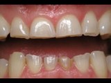 Mẹo Vặt Cuộc Sống - 99% đánh răng ngay sau khi ăn là thói quen sai lầm