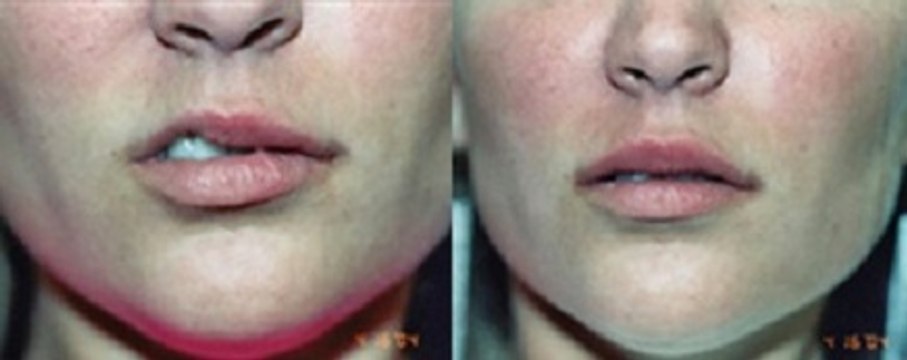 Lip Augmentation - Silicone, Fillers, Injectables