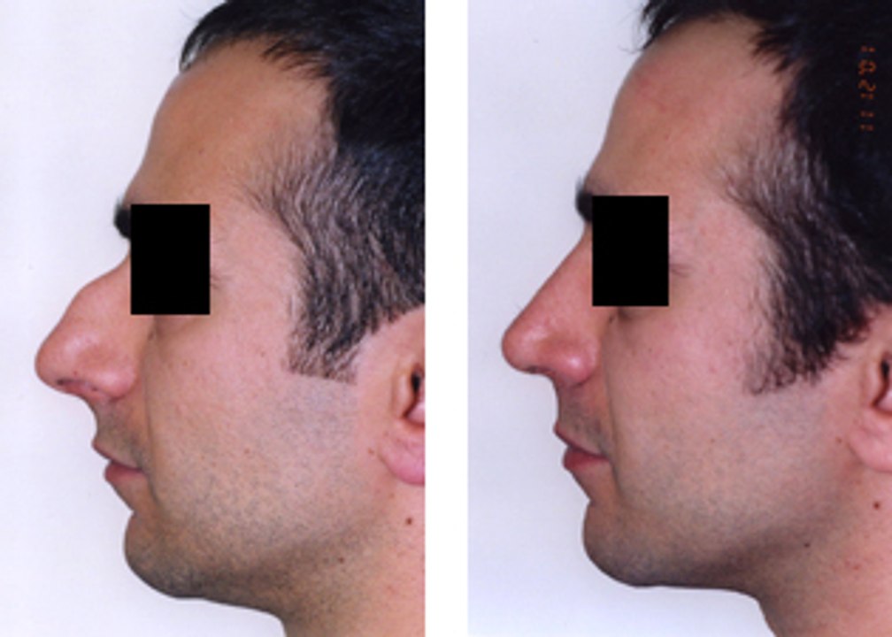Fixing a Large Bump with Rhinoplasty