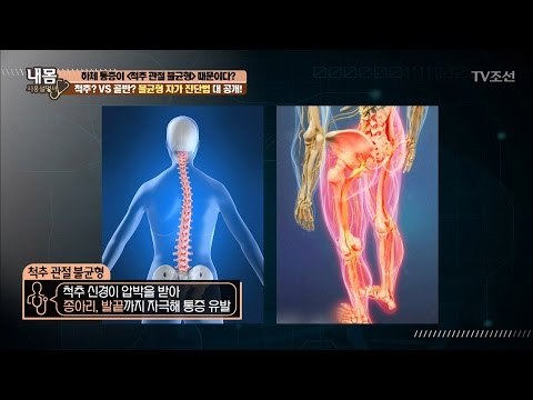 하체통증 유발하는 불균형! 자가 진단법은? [내 몸 사용설명서] 148회 20170407