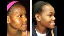 Botswana 100% Nature Cream-Pills Injections 0027736244753 for Skin Lightening Harare