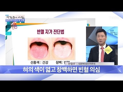 나는 빈혈일까? ‘빈혈 자가 진단법’ [광화문의 아침] 444회 20170320