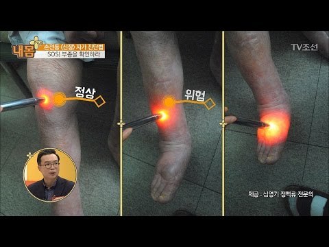 손전등으로 알아보는 신장 자가 진단법 [내 몸 플러스] 50회 20170319