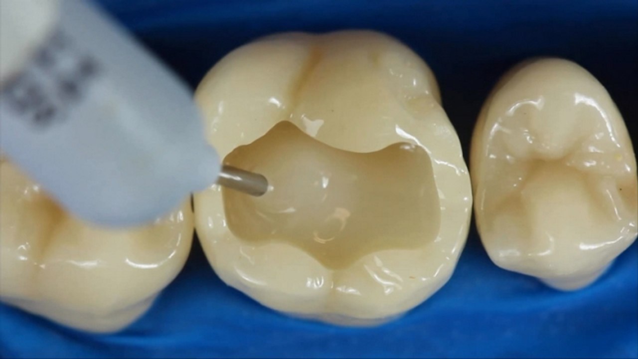 Diş Dolgusu Nasıl Yapılır?