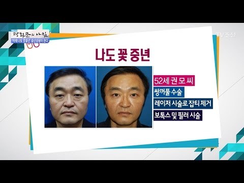 성형으로 꽃중년 된 케이스 [광화문의 아침] 430회 20170227