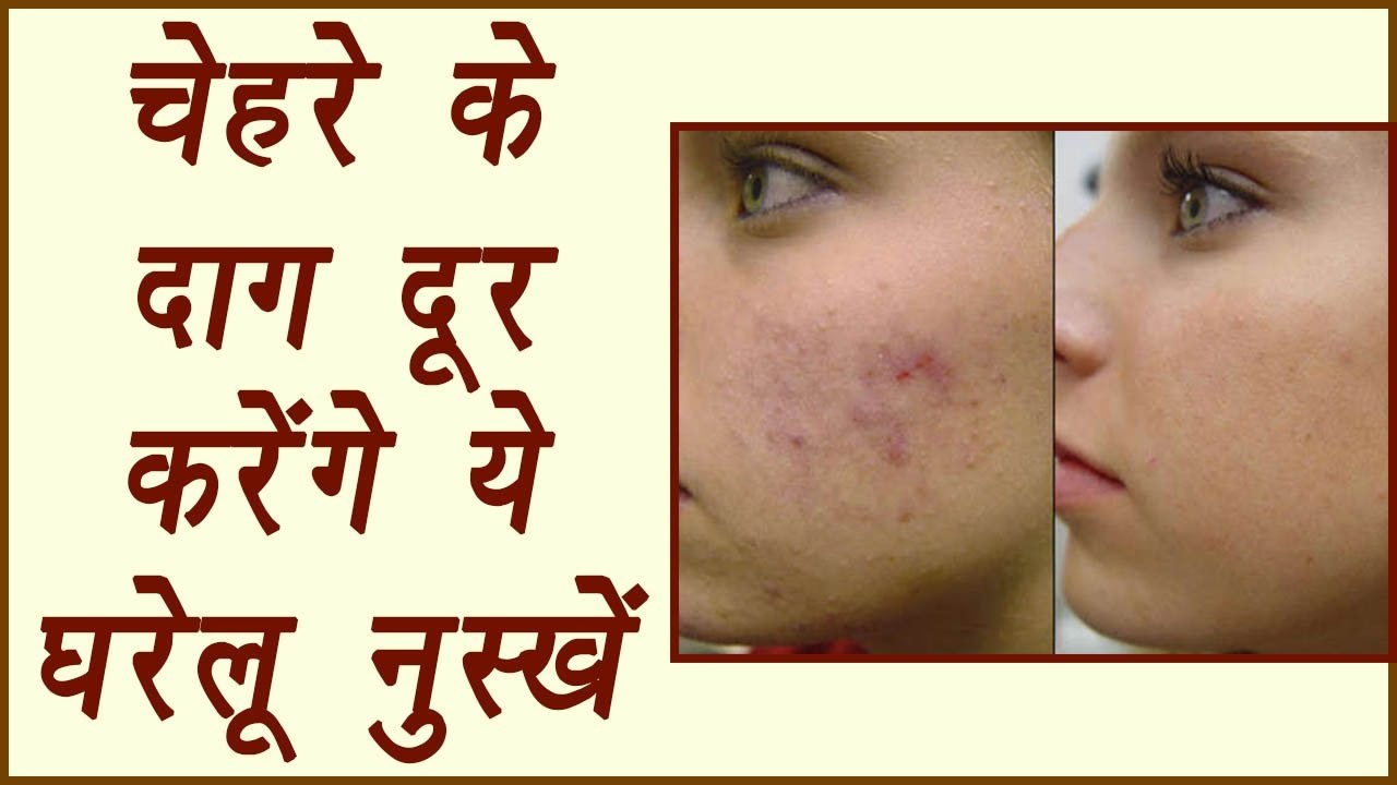 Skin Scars removal remedies | चेहरे के दाग दूर...