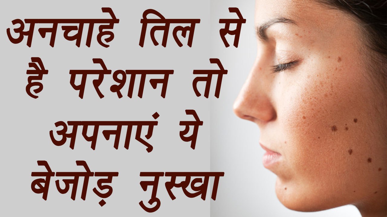 Mole removal home remedies, तिल हटाने के घरेलू उपाय | तिल से है परेशान तो अपनाएं ये नुस्खा | BoldSky