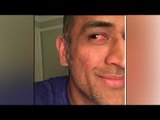MS Dhoni hit on eye by during Ind vs Zim T20, shares pic of red eye | Oneindia News