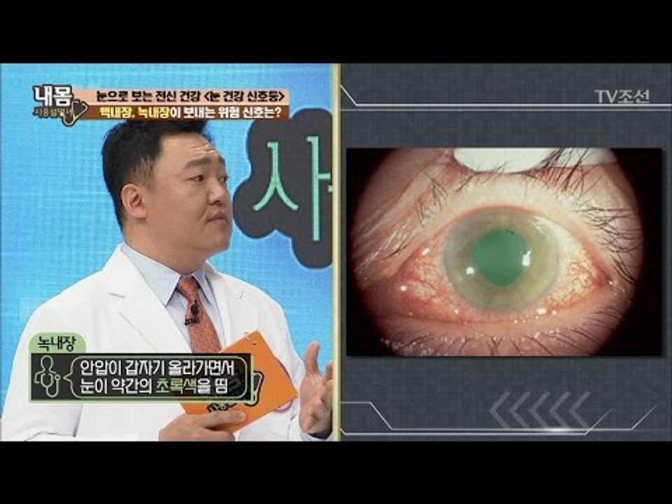 눈에 ‘이것’ 있다면 매우 위험한 상태! [내 몸 사용설명서] 150회 20170421