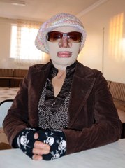 6 Yıl Önce Yangında Yüzü Yanan Kadın Maskesini Çıkardı