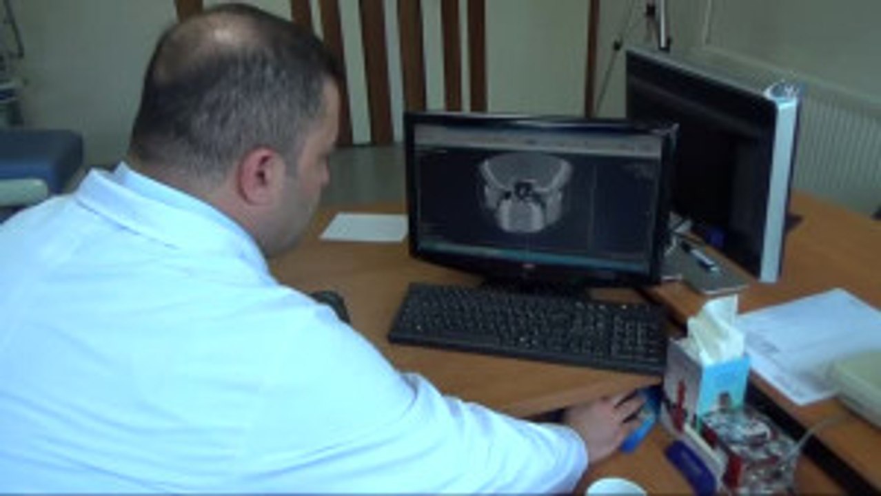 Burun Kemiği Eğriliği Tedavisi Sadece Cerrahidir"