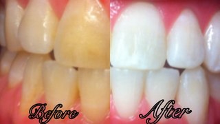 How To Whiten Your Yellow Teeth in 2 minutes || Teeth Whitening At Home