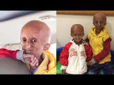 Nihal Bitla, the progeria disorder survivor, passes away| Oneindia News