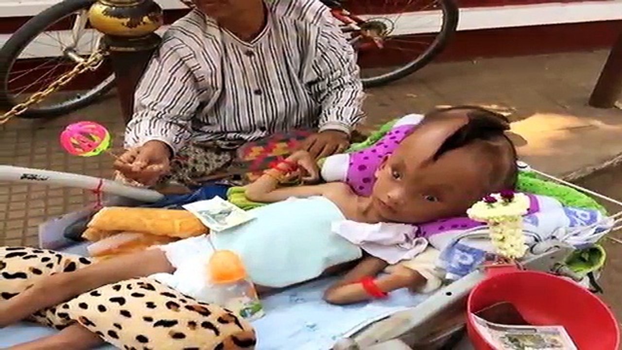 जन्म से ही दो हिस्सों में बंटा हुआ है इस बच्चे का सिर