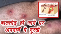 बालतोड़ को ठीक करेंगें यें घरेलु नुस्खे , Treat Boils with these Home remedies | Boldsky