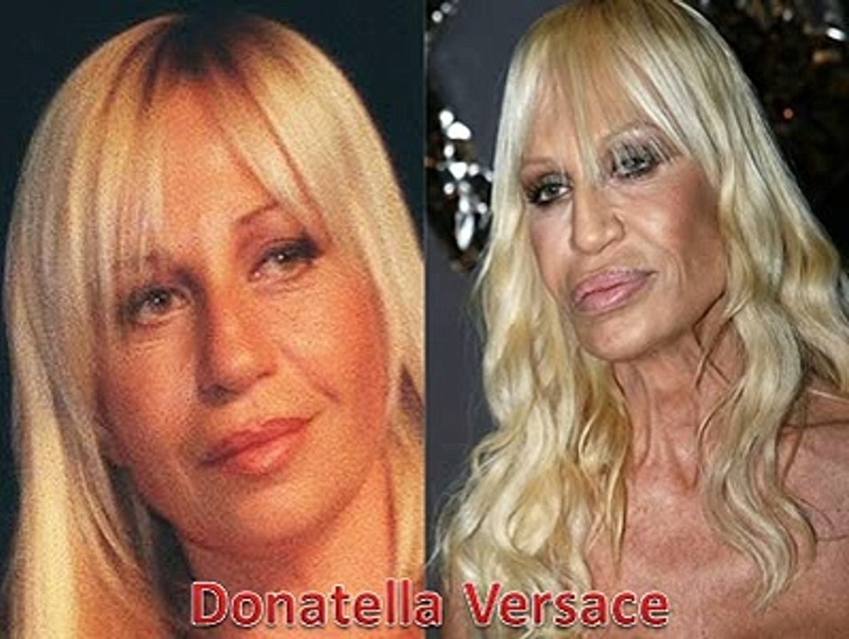 10 Worst Cases Of Plastic Surgery Gone Wrong : Before and After