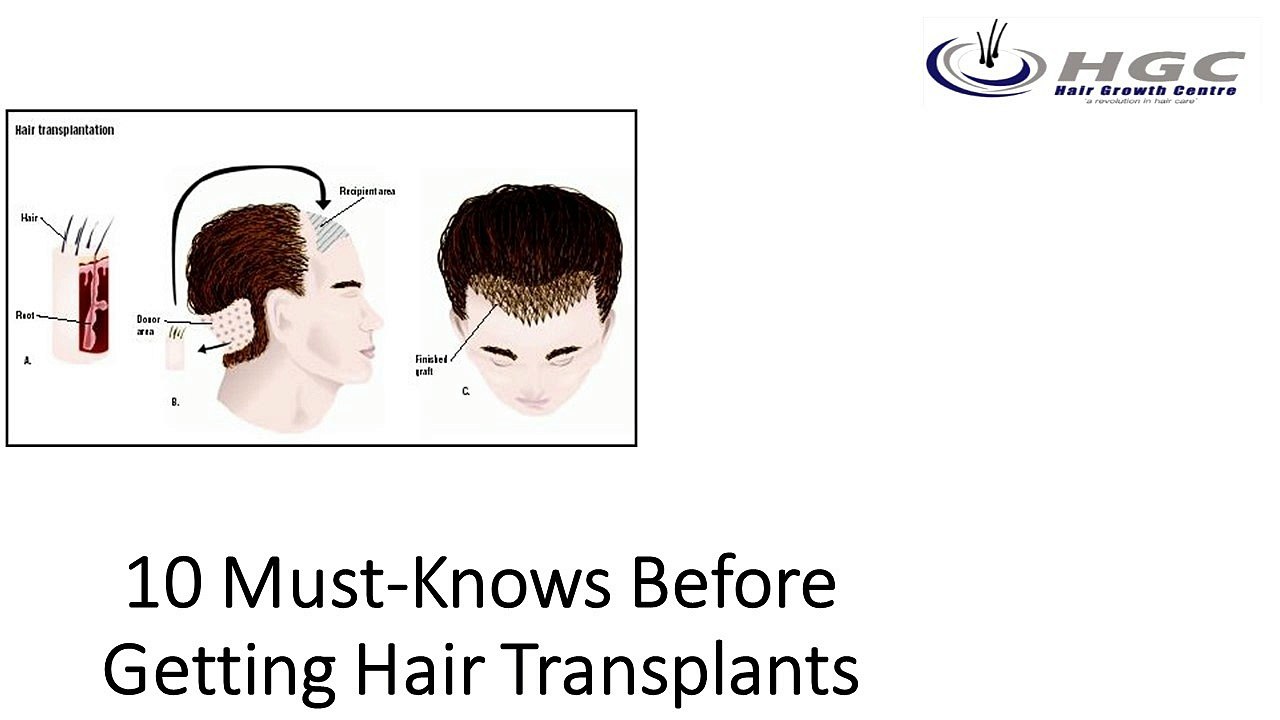 10 Must-Knows Before Getting Hair Transplants