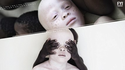 Fotos conscientizam sobre situação de albinos na África