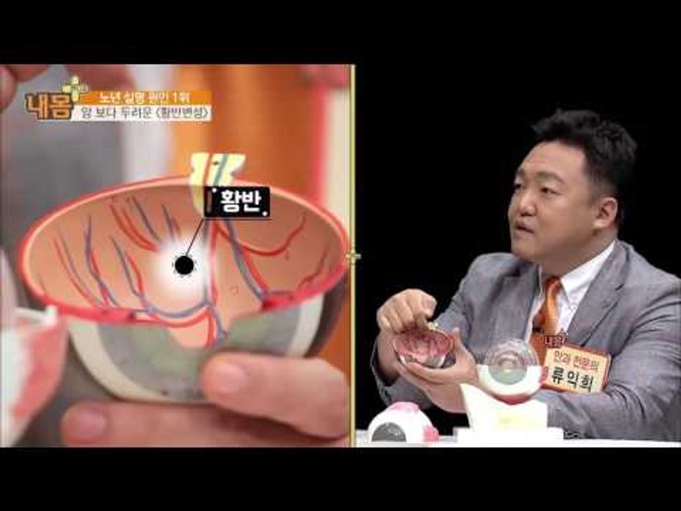 노년 실명 원인 1위 ‘황반변성’ [내 몸 플러스] 30회 20161030