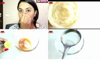 How to Remove BLACK SPOTS , DARK SPOTS & ACNE SCARS on face _ONLY in 5 days