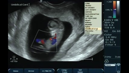 11 Haftalık Gebelik ve Bebeğin Ultrasondaki Görüntüleri