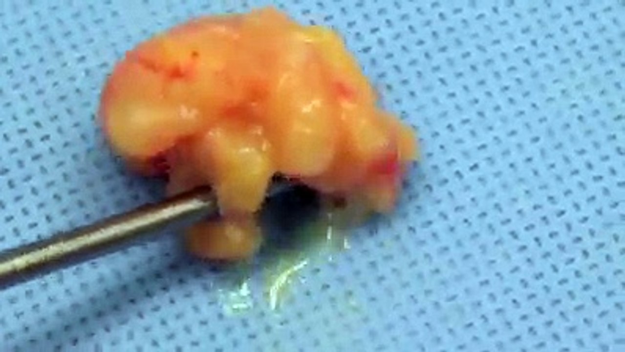 Vaser Lipo - Liposuction For Men