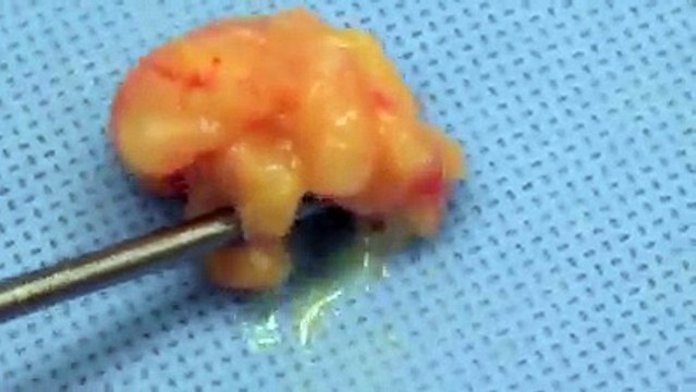 Vaser Lipo - Liposuction For Men