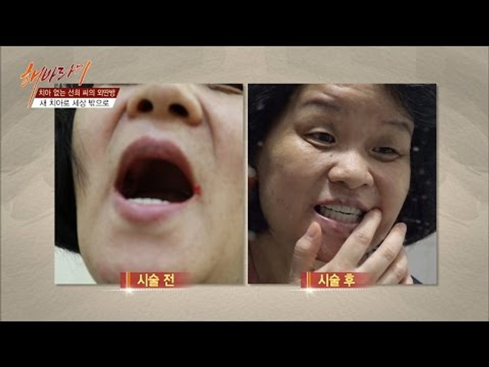 임플란트 시술을 받은 선희씨, 과연 결과는? [해바라기2] 4회 20161001