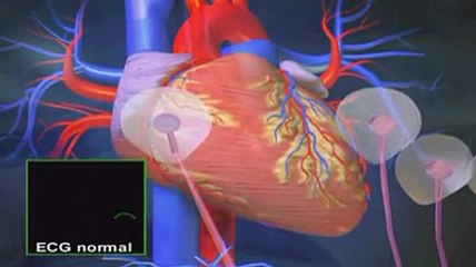 La fibrillation auriculaire expliquée en vidéo