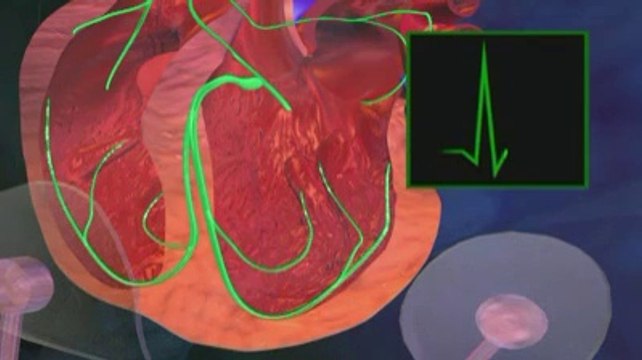 Le test d'effort / ECG expliqué en vidéo