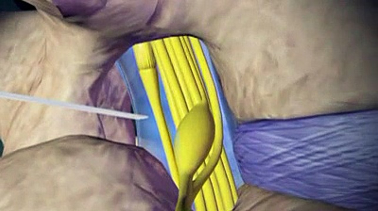 Injections spinales