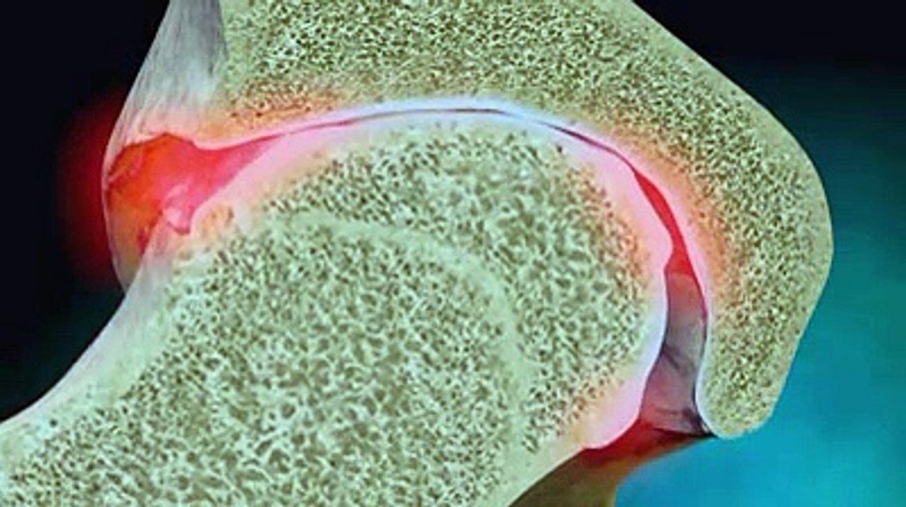 Ostéoarthrite de la hanche