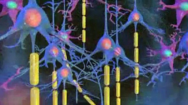 La sclérose en plaques (SEP) expliquée en vidéo