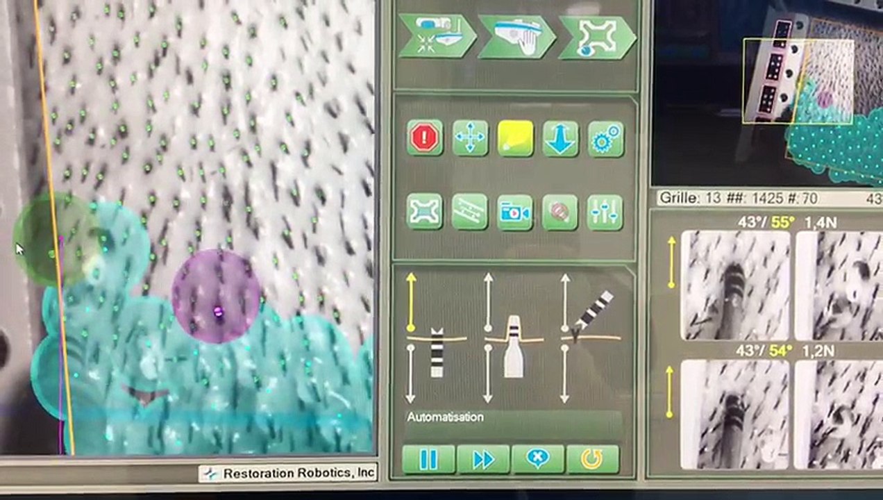 Prelevement_greffons_TheClinic_ARTAS_04-17