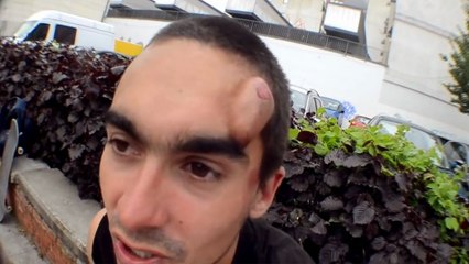 Il se fait une bosse énorme en chutant en skateboard