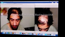 Best FUE Hair Transplant in Delhi, INDIA By Dr. Amrendra Kumar