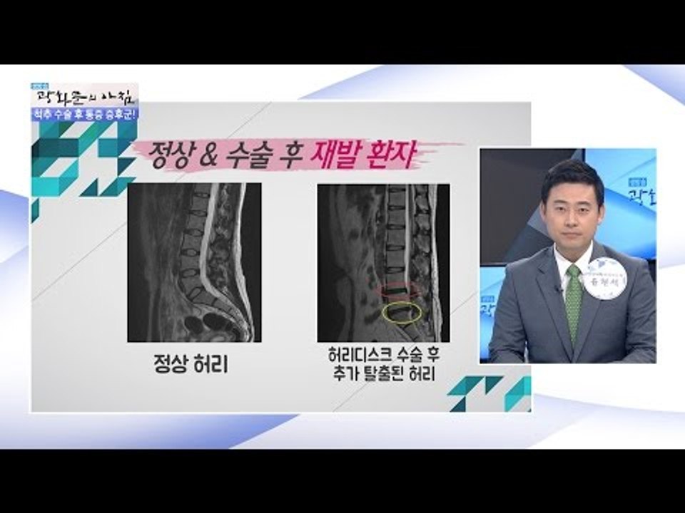 척추 수술 후 통증이 악화되는 ‘통증 증후군’ [광화문의 아침] 311회 20160906
