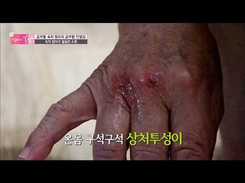 온 몸 성한 곳이 없는 엄마의 몸. [엄마의 봄날] 54회 20160814