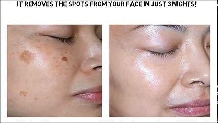 It Removes The Spots From Your Face In Just 3 Nights! - YouTube