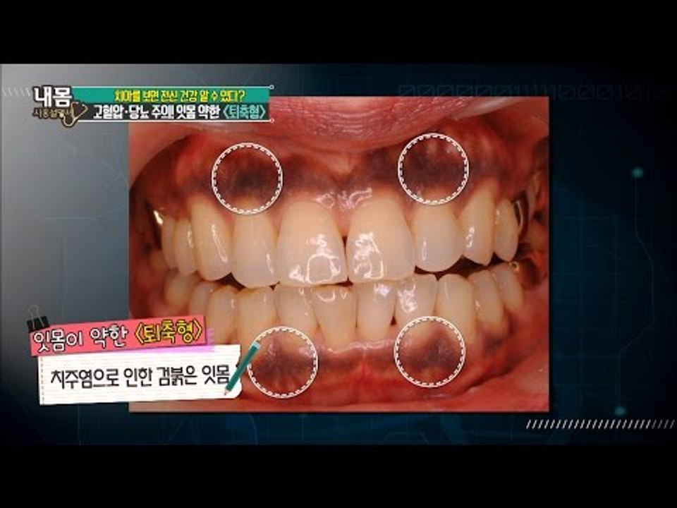 치아로 보는 전신건강! 고혈압, 당뇨 주의! ‘퇴축형 치아’ [내 몸 사용설명서] 1...