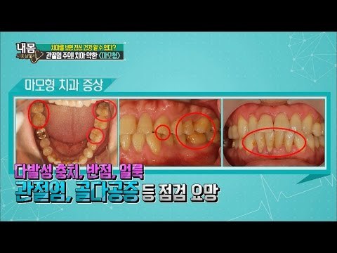 치아로 보는 전신건강! 관절염 주의! ‘마모형 치아’ [내 몸 사용설명서] 114회 20160805