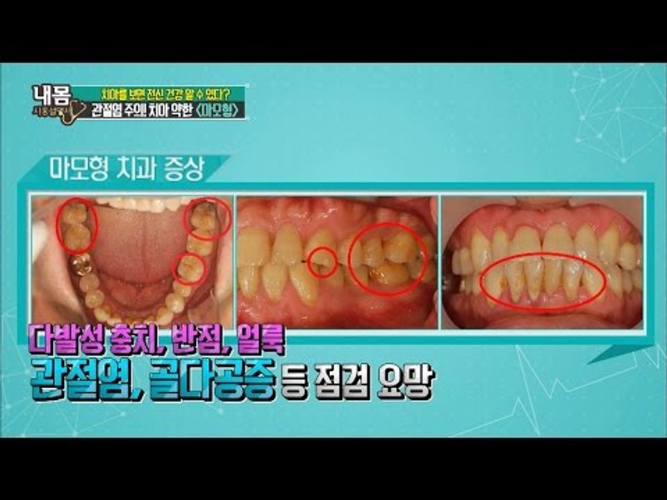 치아로 보는 전신건강! 관절염 주의! ‘마모형 치아’ [내 몸 사용설명서] 114회...