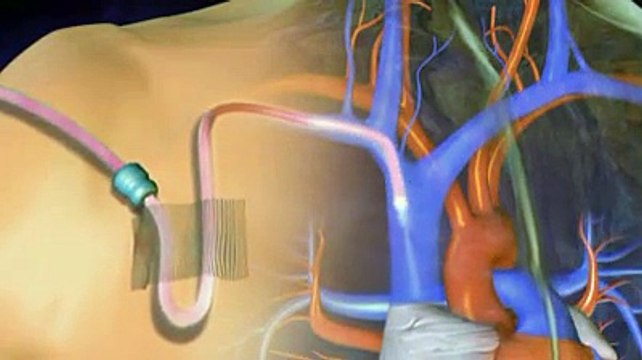 Cathéter veineux central et cathéter veineux périphérique