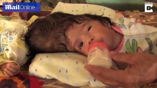 Pakistani conjoined twins are hoping for a miracle