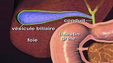Ablation de la vésicule biliaire en vidéo