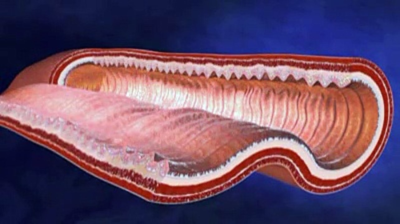 Gastroplastie verticale calibrée