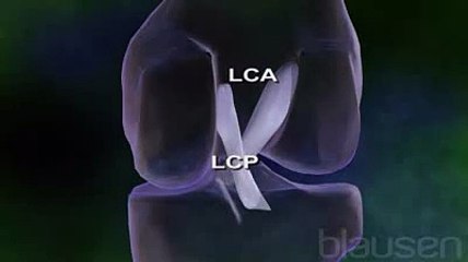 La rupture du ligament croisé antérieur expliquée en vidéo