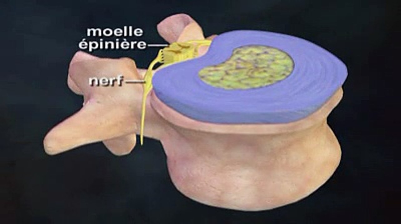 La hernie discale en vidéo