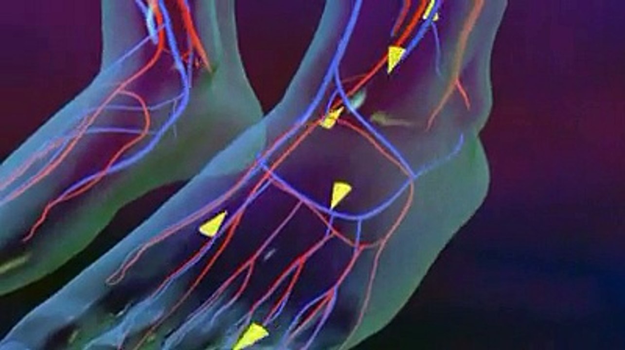 Les varices expliquées en vidéo